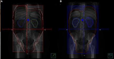 Radiation Treatment in Women with Ovarian Cancer: Past, Present, and Future